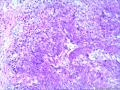 宫内膜及宫颈口赘生物图19