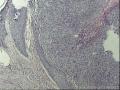 下眼睑表皮肿物图9