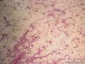 请老师们看看这个左大腿肿块图4