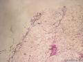 请老师们看看这个左大腿肿块图1