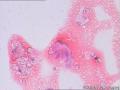 左侧甲状腺包块图14