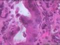 请教，贲门下缘粘膜，乳头状腺瘤伴低级别。。？图12