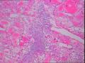 甲状腺癌？1-5左侧，其余右侧图5