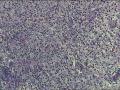 脾破裂图1