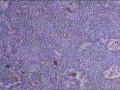 颜面部黑痣图1