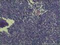 脾破裂图13