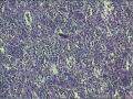 脾破裂图5