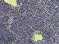 脾破裂图3