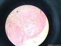 乳腺纤维腺瘤？腺病？图6