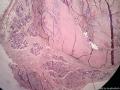 乳腺纤维腺瘤？腺病？图11