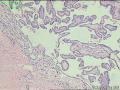 甲状腺，乳头状癌？瘤？图1