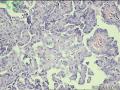 甲状腺，乳头状癌？瘤？图6