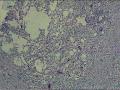 结石性胆囊炎图3