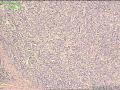电切前列腺组织，癌？图2