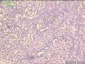电切前列腺组织，癌？图1