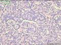 电切前列腺组织，癌？图6