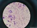 右侧腹股沟结节穿刺图11