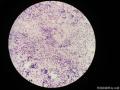 右侧腹股沟结节穿刺图21