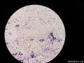 右侧腹股沟结节穿刺图17