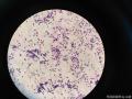 右侧腹股沟结节穿刺图15
