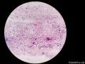 右侧腹股沟结节穿刺图16