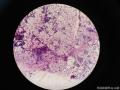 右侧腹股沟结节穿刺图8