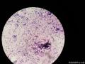 右侧腹股沟结节穿刺图20