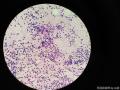 右侧腹股沟结节穿刺图22