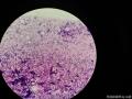 右侧腹股沟结节穿刺图26