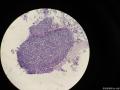 右侧腹股沟结节穿刺图3