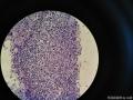 右侧腹股沟结节穿刺图2