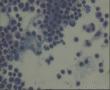 请老师看看33岁腹水脱落细胞图1
