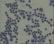 请老师看看33岁腹水脱落细胞图2