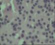 请老师看看33岁腹水脱落细胞图16