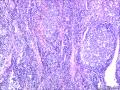儿童型滤泡性淋巴瘤？图11