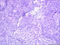 儿童型滤泡性淋巴瘤？图14