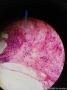 甲状腺结节穿刺图7
