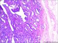 乳腺包块，结节性腺病？图1