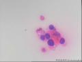 甲状腺穿刺，有事吗？图8