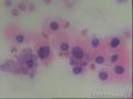甲状腺穿刺，有事吗？图3