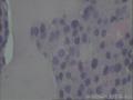 甲状腺肿物图27