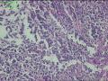 贲门活检组织，低分化腺癌？图5