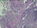 贲门活检组织，低分化腺癌？图4