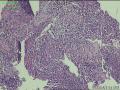 贲门活检组织，低分化腺癌？图2
