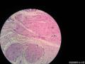 乳腺带皮组织一块，怎么诊断？？？图3