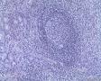 请教老师胃的淋巴瘤怎么诊断啊，这例是什么？图9