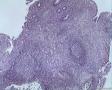 请教老师胃的淋巴瘤怎么诊断啊，这例是什么？图5