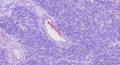 男，71岁，右鼻腔新生物图5