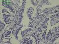 直肠活检组织，绒毛状腺瘤？图8