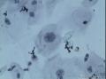 38岁，ASC-US？OR  LSIL？图6